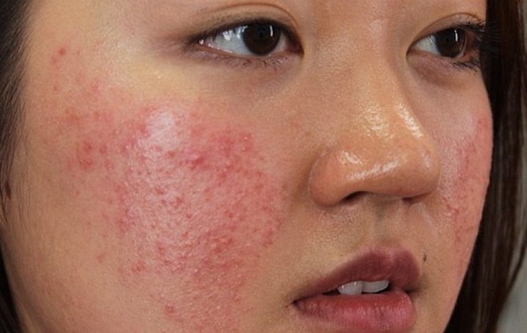Mụn kích ứng là gì? Nguyên nhân nào gây nên mụn kích ứng