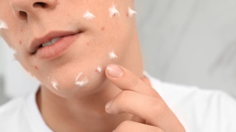 Việc không dùng chống nắng là một trong những nguyên nhân khiến mụn thâm kéo dài, khó phục hồi.