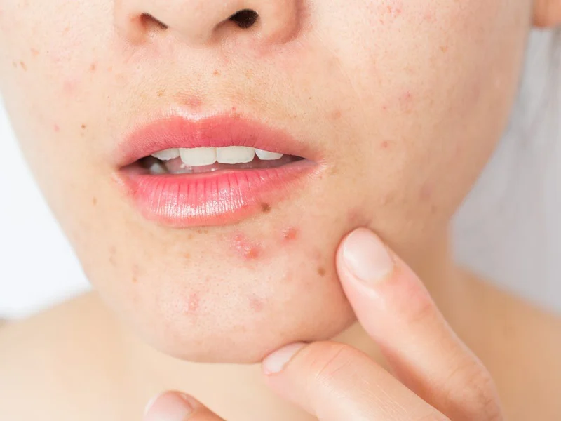 Thay đổi nội tiết tố là một trong những nguyên nhân chính gây mụn nội tiết ở cằm
