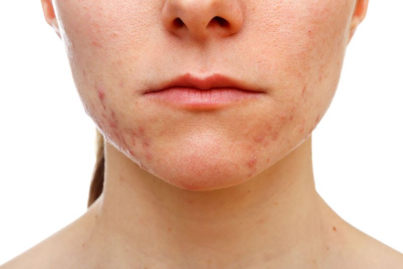 Cách điều trị mụn nội tiết ở nữ hiệu quả và an toàn