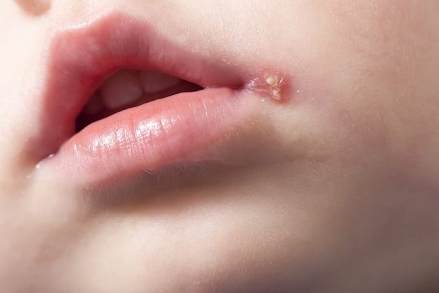 Cách điều trị mụn nước quanh miệng hiệu quả và an toàn