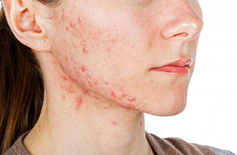 Nguyên nhân gây ra mụn ở quai hàm