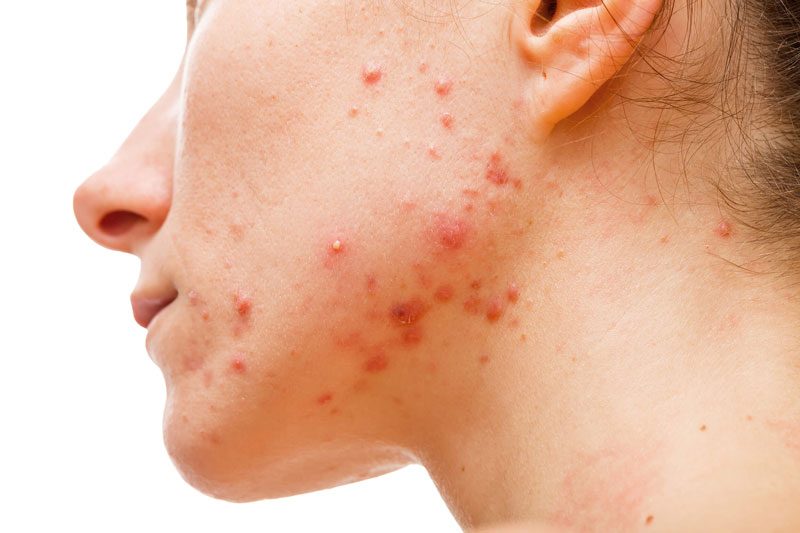 Mụn trứng cá mủ là gì? Nguyên nhân nào gây nên mụn trứng cá mủ