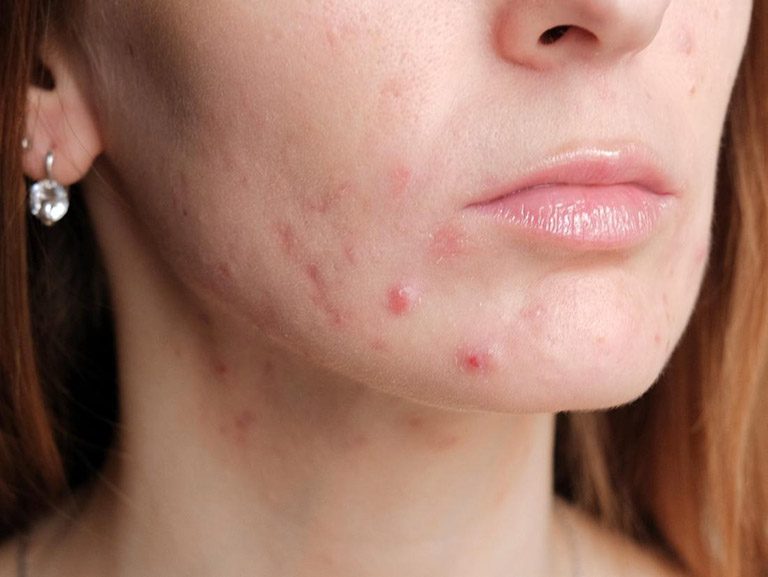 Cân bằng và kháng viêm là bước không thể thiếu khi trị mụn trứng cá mủ
