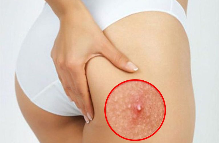 Nguyên nhân nào gây mụn trứng cá ở mông