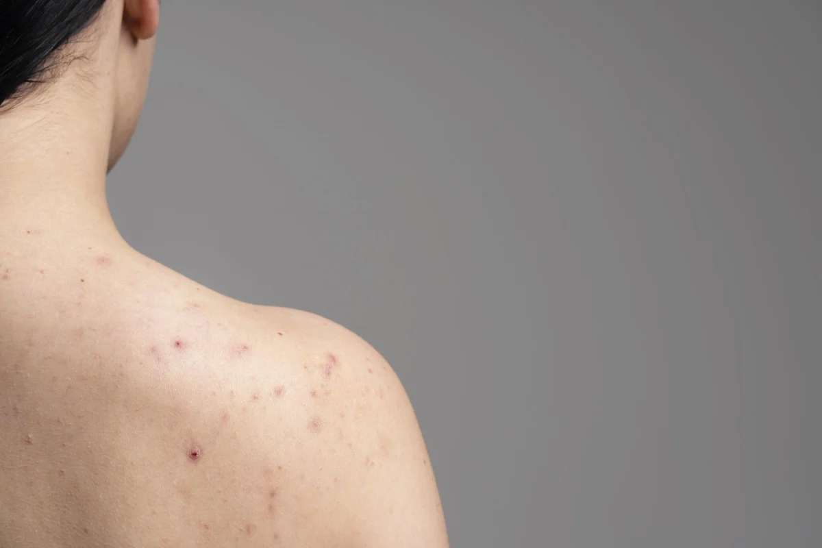 Tìm hiểu nguyên nhân gây mụn trứng cá ở vai