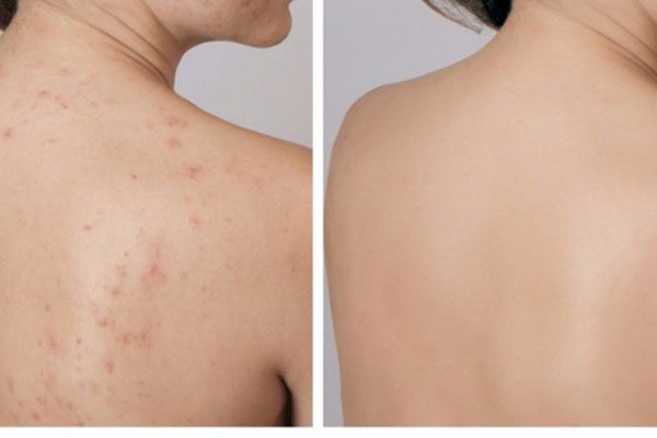 Việc điều trị mụn vai cần kết hợp nhiều phương pháp để đạt được hiệu quả tối ưu. Điều quan trọng là lựa chọn cách chăm sóc phù hợp với loại da và mức độ mụn.