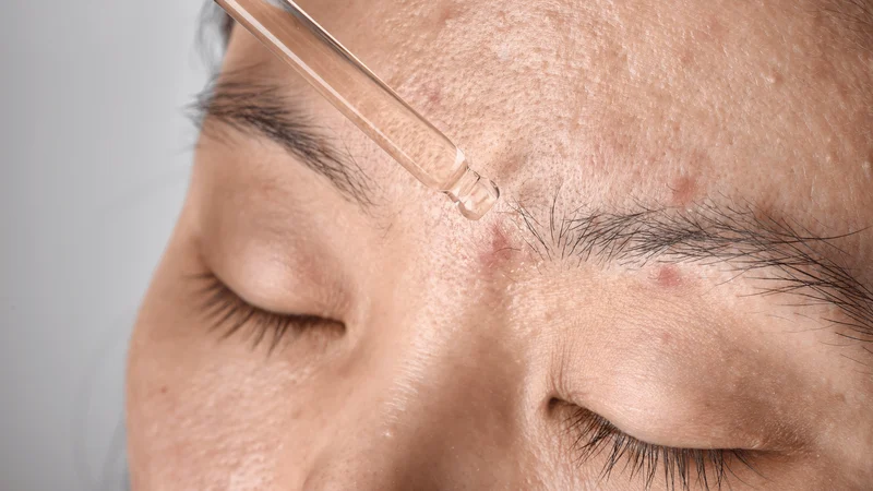 Niacinamide trị mụn thâm? Chính vì những cơ chế tác động đa chiều này, Niacinamide ngày càng trở thành lựa chọn hàng đầu trong các phác đồ điều trị mụn thâm của chuyên gia da liễu.
