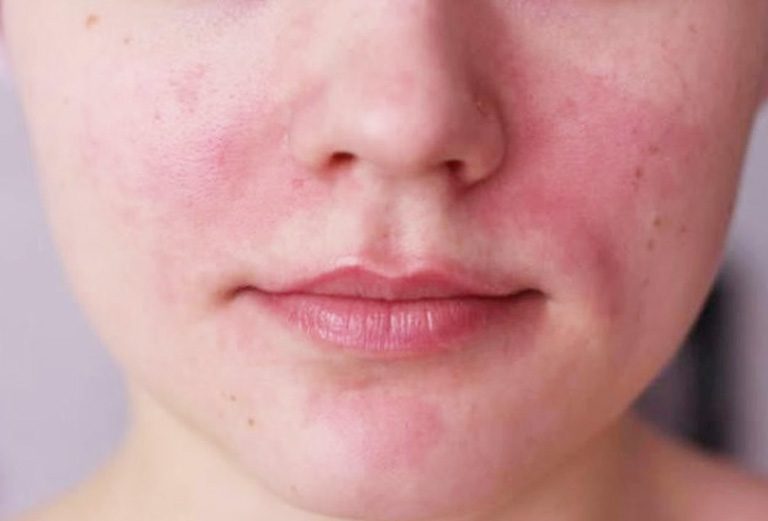 Nguyên nhân khiến da bị kích ứng khi sử dụng nước tẩy trang