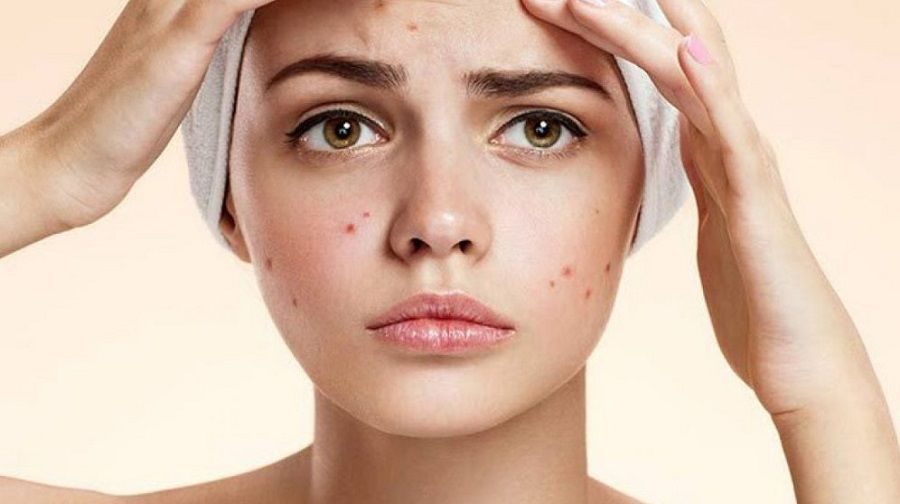 Nước tẩy trang cho da mụn: Lựa chọn phù hợp để bảo vệ làn da