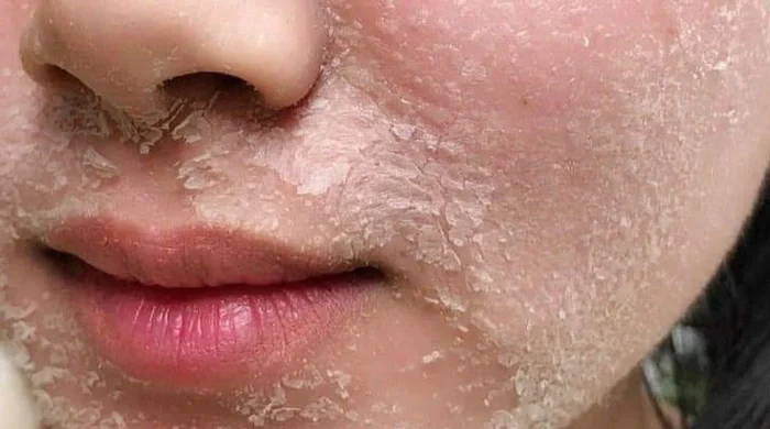 Cách Xử Lý Khi Peel Da Bị Bỏng Đỏ Rát