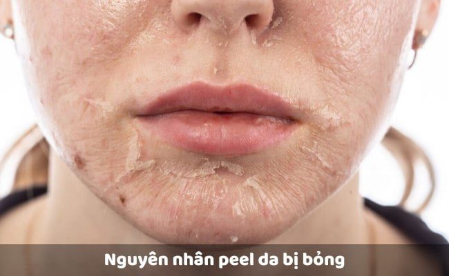 Nguyên nhân nào khiến peel da bị bỏng đỏ rát phải làm gì