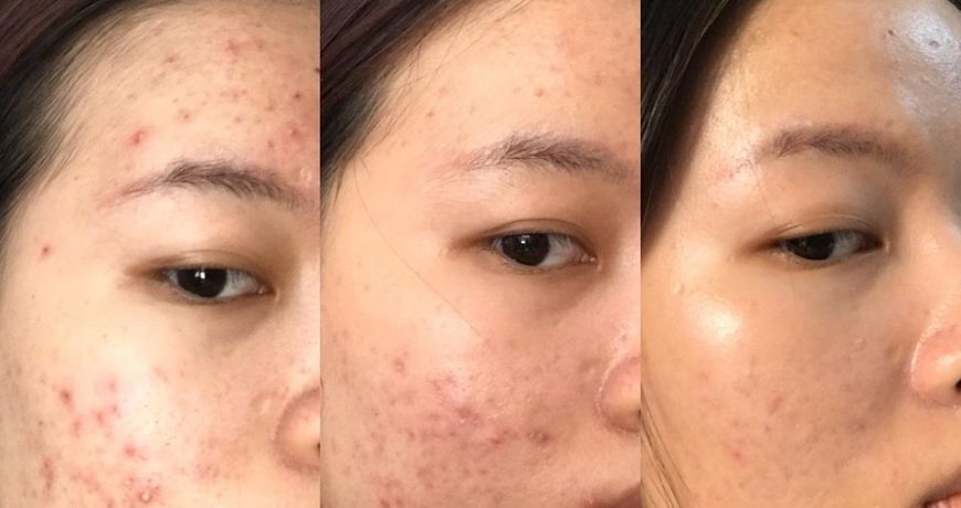 Quy trình sử dụng retinol trị mụn ẩn đúng cách