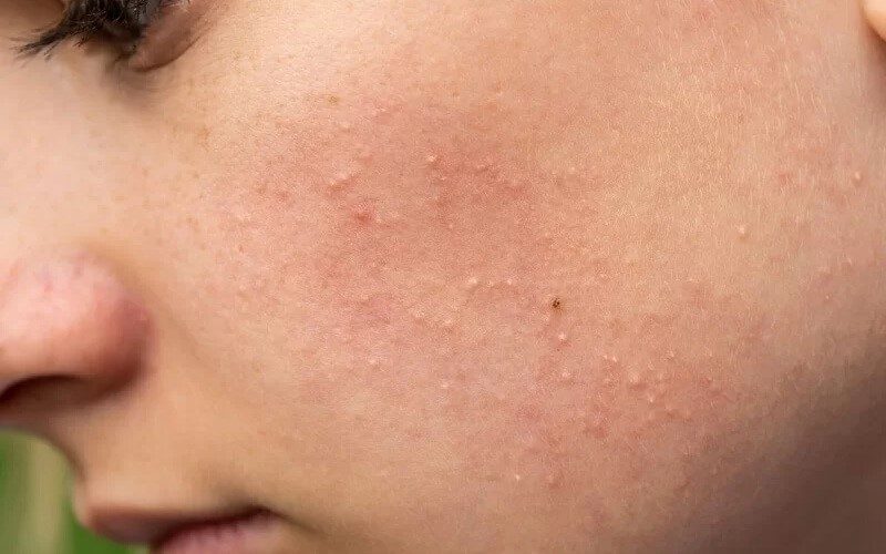 Hiểu được tình trạng của da giúp người chăm sóc có hướng xử lý phù hợp, hạn chế biến chứng và đẩy nhanh quá trình phục hồi.