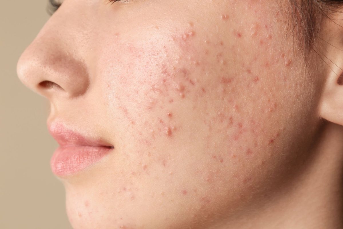 Việc hiểu đúng nguyên nhân này là tiền đề quan trọng để lựa chọn đúng dòng serum trị mụn dị ứng, giúp làm dịu da nhanh chóng, hỗ trợ phục hồi hàng rào bảo vệ tự nhiên.
