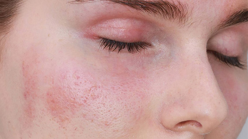Cách chọn sản phẩm skincare phù hợp với da nhạy cảm trong mùa hè