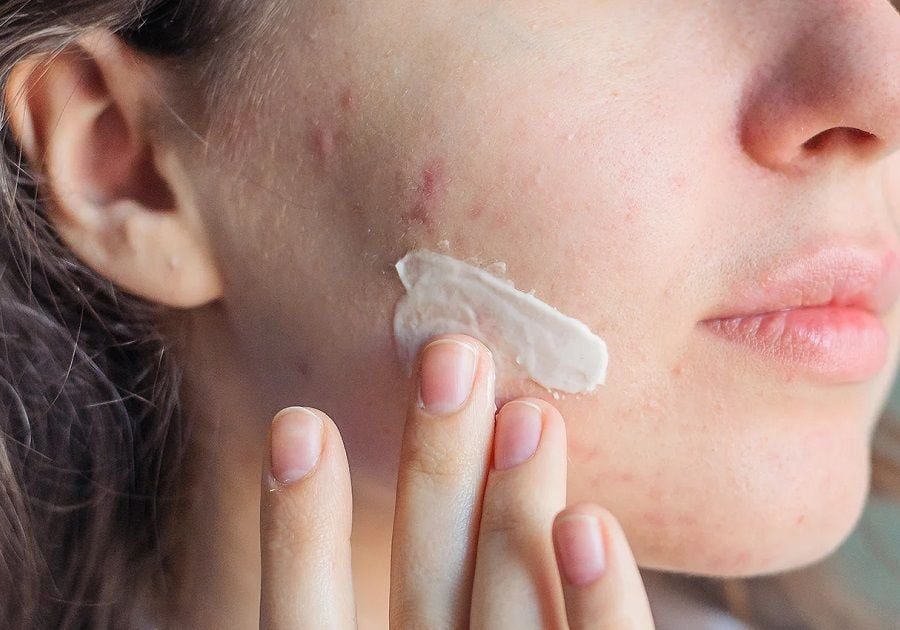 Những lưu ý quan trọng khi chăm sóc da sau khi nặn mụn