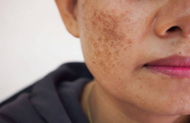 Do đó, muốn duy trì làn da đều màu, việc dùng thuốc cần kết hợp với lối sống khoa học, chăm sóc da đều đặn và bảo vệ da khỏi nắng mỗi ngày.