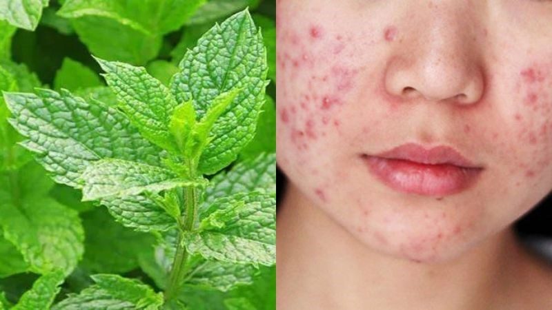 Trị mụn bằng lá bạc hà giúp kháng khuẩn và tái tạo da hiệu quả