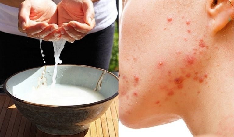 Tuy nhiên, hiệu quả của việc trị mụn bằng nước vo gạo còn phụ thuộc rất nhiều vào cách bạn sơ chế, bảo quản và áp dụng vào quy trình chăm sóc da hàng ngày.