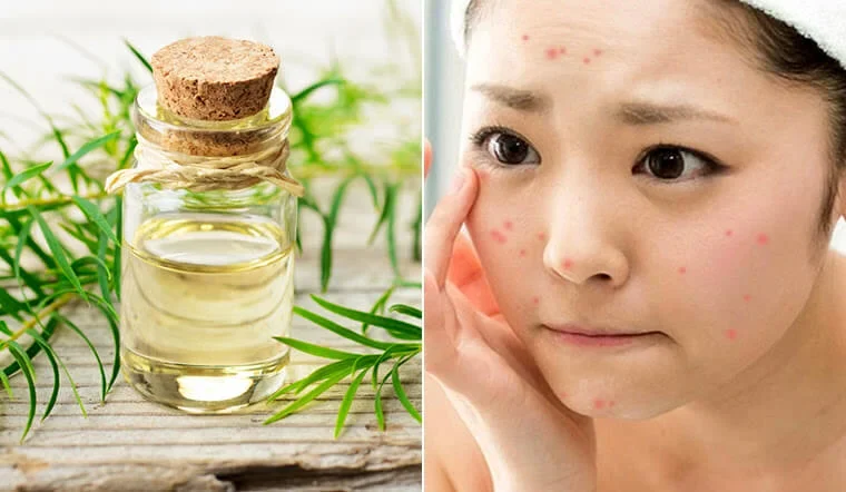 Ngoài ra, tinh dầu tràm trà còn có tác dụng làm mờ vết thâm do mụn để lại nếu sử dụng lâu dài và đều đặn. Tuy nhiên, cần có sự hiểu biết rõ ràng để tránh tình trạng kích ứng da.
