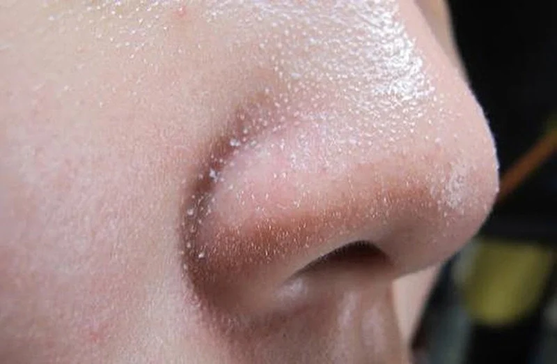 Hiểu rõ nguyên nhân là bước đầu tiên và quan trọng trong quá trình trị mụn cám ở mũi hiệu quả và bền vững.