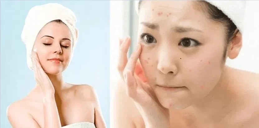 Thói quen chăm sóc da hằng ngày hỗ trợ giảm mụn cho bà bầu hiệu quả