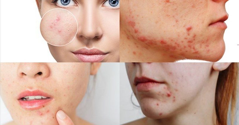 Hiểu rõ nguyên nhân sẽ giúp xác định được hướng điều trị chính xác và cá nhân hóa phác đồ chăm sóc da lẫn sức khỏe tổng thể.
