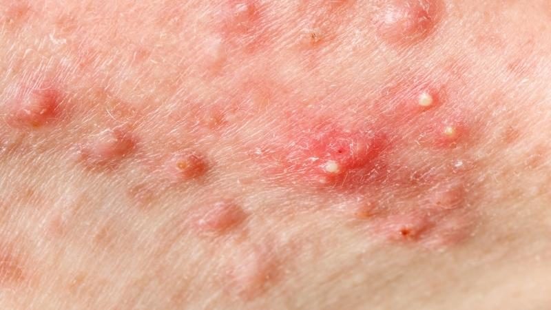 Nguyên nhân khiến nam giới dễ bị mụn trứng cá nặng hơn phụ nữ