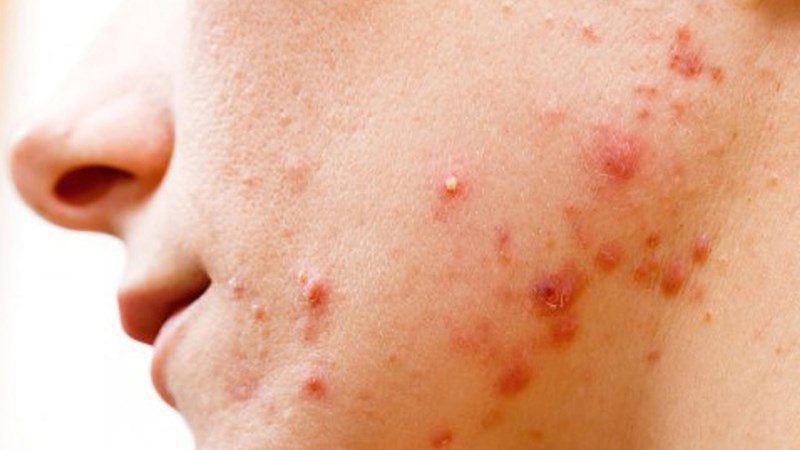Các phương pháp điều trị mụn trứng cá nặng ở nam giới hiện nay