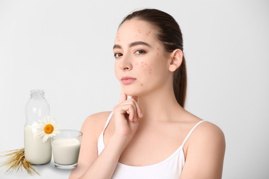 Uống sữa có bị nổi mụn không? Mối liên quan giữa sữa và cơ thể