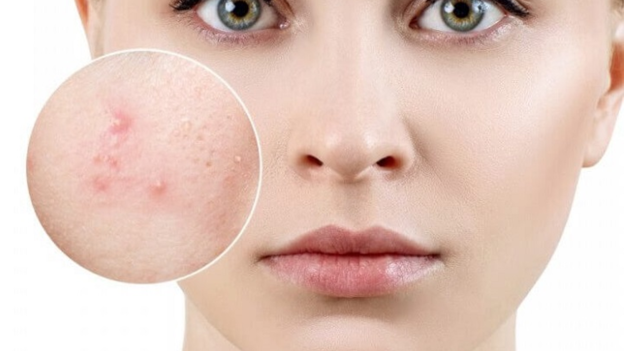 Nguyên nhân gây mụn ở tuổi dậy thì và vai trò của vitamin