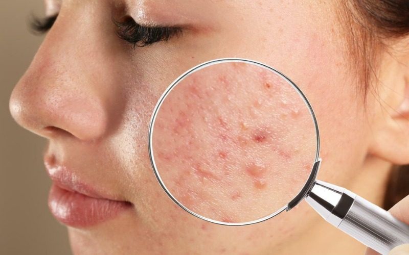 Cách kết hợp xịt khoáng vào quy trình skincare trị mụn hiệu quả