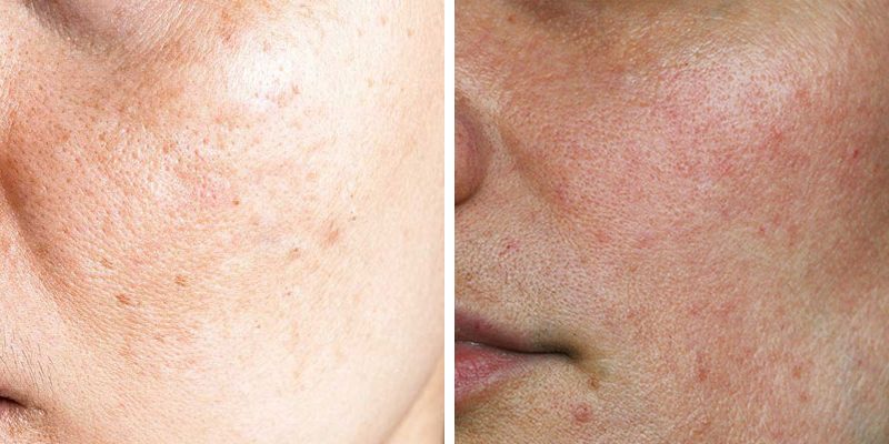 Sự thay đổi này khiến da bà bầu dễ bị tổn thương và xuất hiện bị nám da