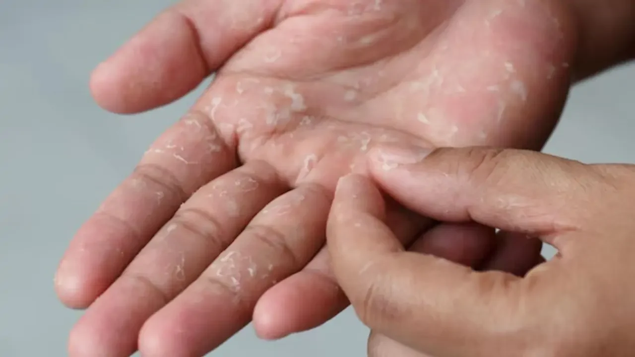 Bị khô da tay là thiếu chất gì? Nhận biết và 3 cách chăm sóc hiệu quả