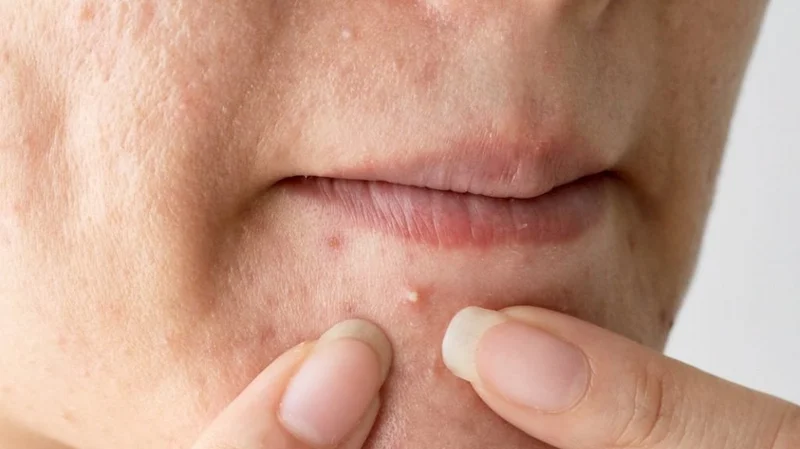 Chăm sóc da bị mụn hiệu quả với sản phẩm Dr.Spiller