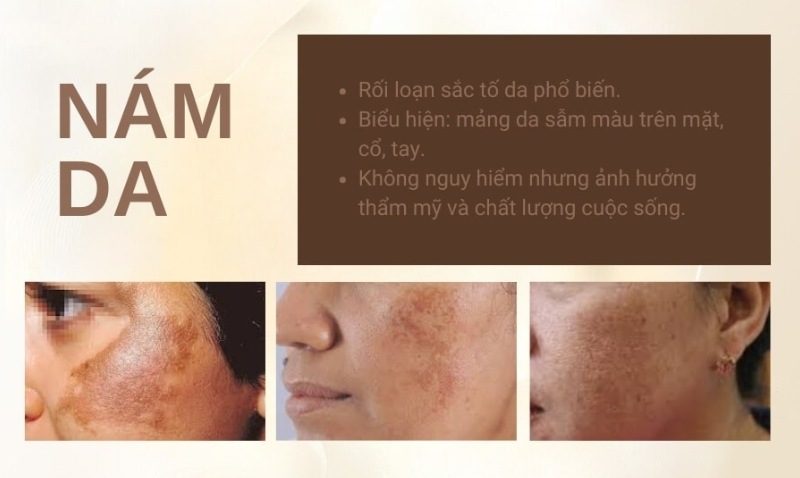Việc lựa chọn các hoạt chất điều trị nám phù hợp là yếu tố tiên quyết giúp khắc phục hiệu quả tình trạng sạm da và thúc đẩy tái tạo làn da sáng khỏe.