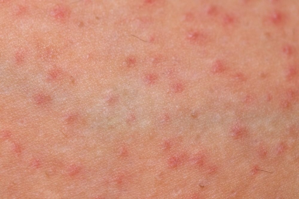 Sản phẩm Dr.Spiller hỗ trợ giảm viêm nang lông hiệu quả