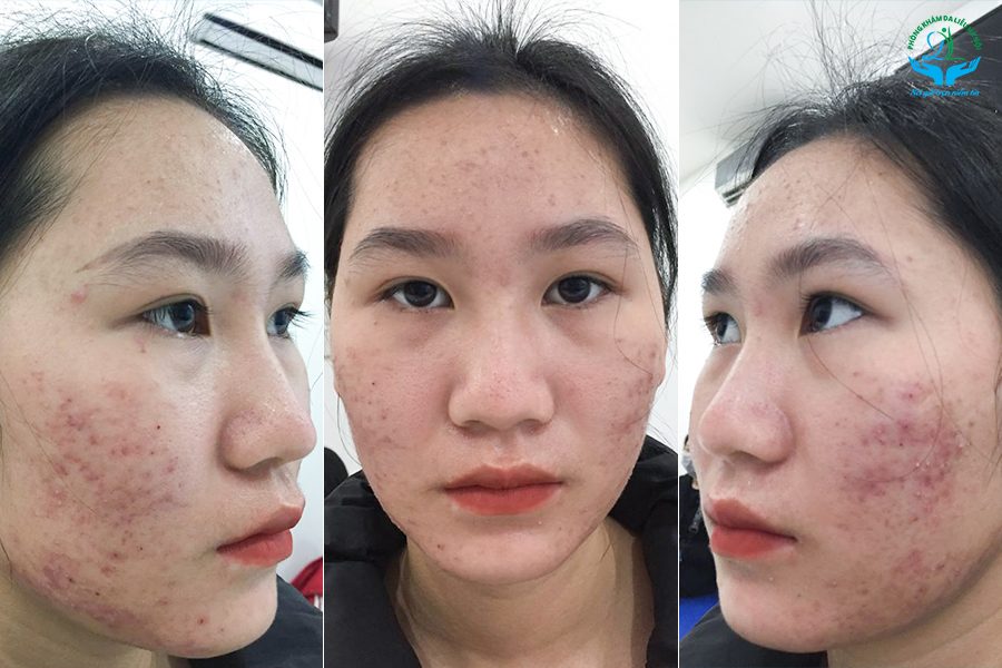Việc xác định nguyên nhân chính là bước đầu trong việc áp dụng hiệu quả cách trị mụn phù hợp, bảo vệ da và ngăn ngừa mụn tái phát trong tương lai.