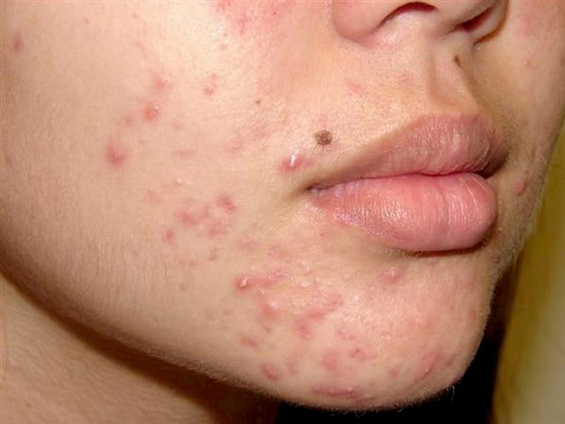 Cách trị mụn bọc nào hiệu quả hiện nay?