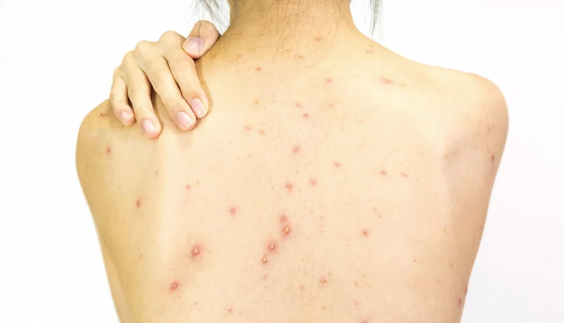 Mụn lưng thường xuất hiện phổ biến trong giai đoạn tuổi dậy thì do nhiều nguyên nhân khác nhau.