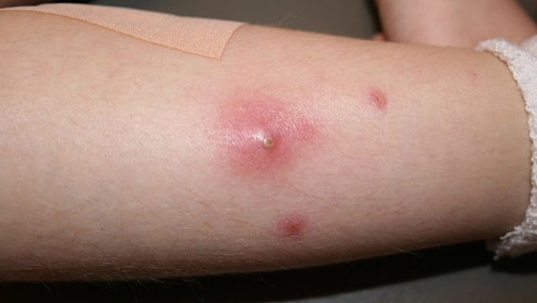 Mụn nhọt ở chân là hiện tượng viêm nhiễm cấp tính của nang lông và tuyến bã do vi khuẩn gây ra, thường là tụ cầu vàng.