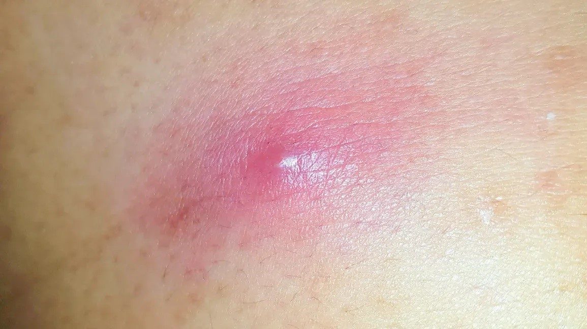 Mụn nhọt ở mông xuất hiện do đa dạng nguyên nhân liên quan đến vệ sinh và sinh hoạt hàng ngày.