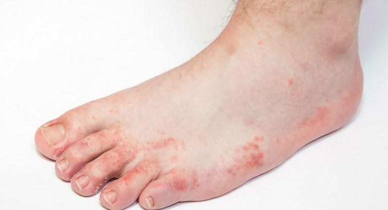 Để bắt đầu quá trình trị mụn nước ở chân tại nhà, việc đầu tiên cần làm là vệ sinh vùng da bị tổn thương thật sạch sẽ.