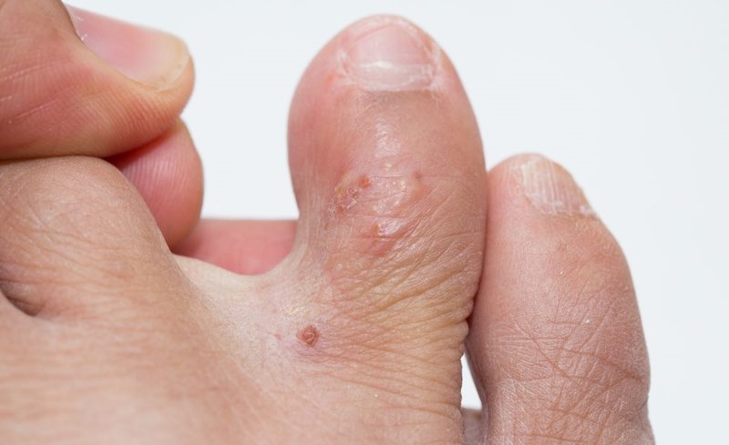 Khi tìm kiếm cách trị mụn nước ở chân tại nhà, sự lựa chọn các sản phẩm chăm sóc da an toàn là vô cùng quan trọng.