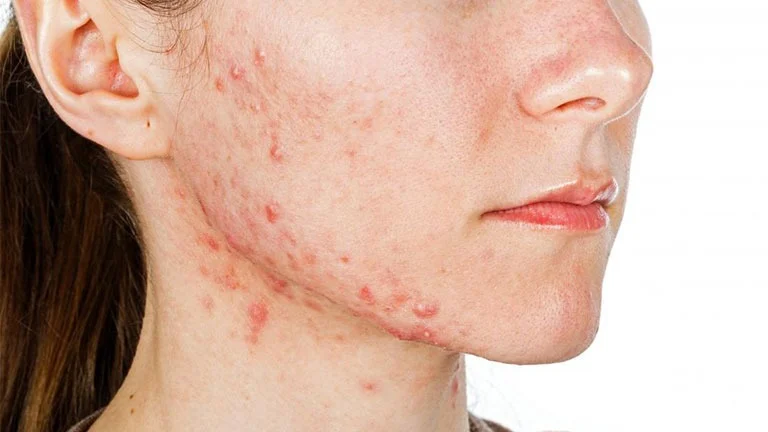 Mụn viêm xuất phát từ nhiều nguyên nhân phức tạp, chủ yếu là do vi khuẩn Propionibacterium acnes phát triển mạnh trong vùng nang lông bị bít kín.
