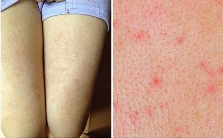 Hiểu rõ nguyên nhân để biết cách trị viêm nang lông hiệu quả