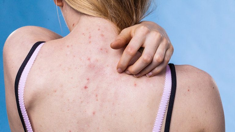 Lưu ý trong quá trình điều trị và phòng ngừa viêm nang lông