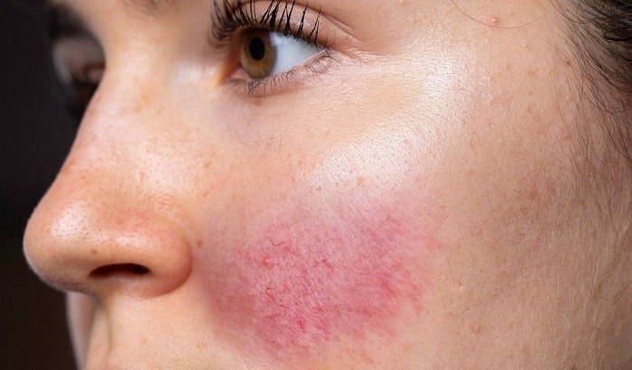 Chăm sóc da nhạy cảm khi giao mùa sao cho hiệu quả