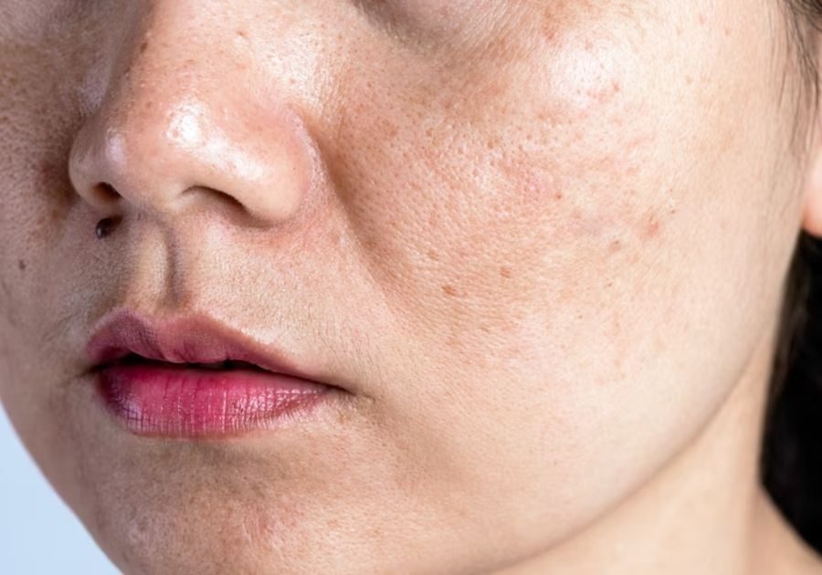 Da bị nám phải làm sao để điều trị hiệu quả trước hết cần hiểu rõ về nguyên nhân xuất hiện nám trên da.